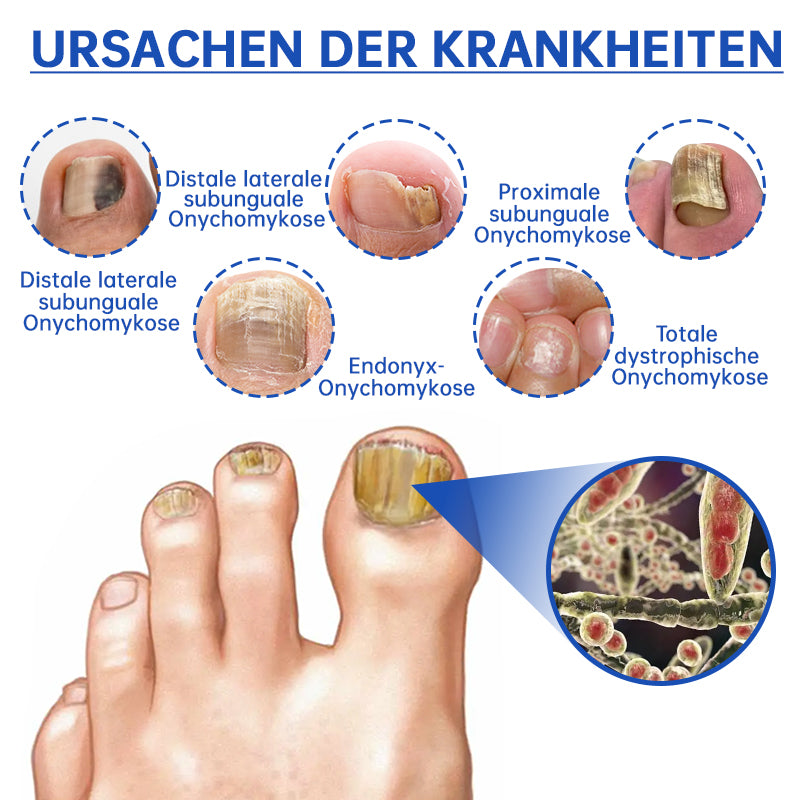 FungiFade™ — Pain-Free Laser Therapy that Restores Gorgeous, Fungus-Free Nails Fast