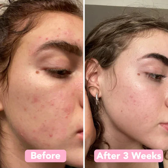 LumiPure™ Pads — Reveal Your Radiant, Even Skin in Just Weeks