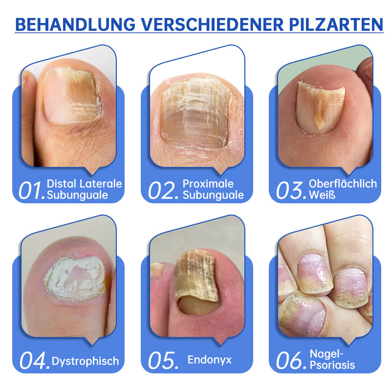 FungiFade™ — Pain-Free Laser Therapy that Restores Gorgeous, Fungus-Free Nails Fast