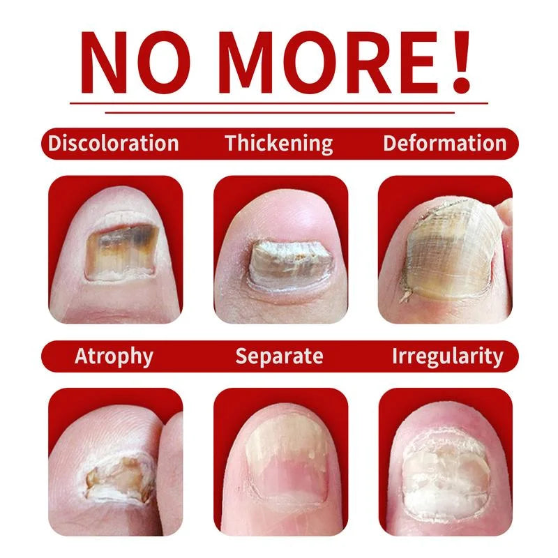 Nail Treatment - Natural Anti-Fungal Treatment