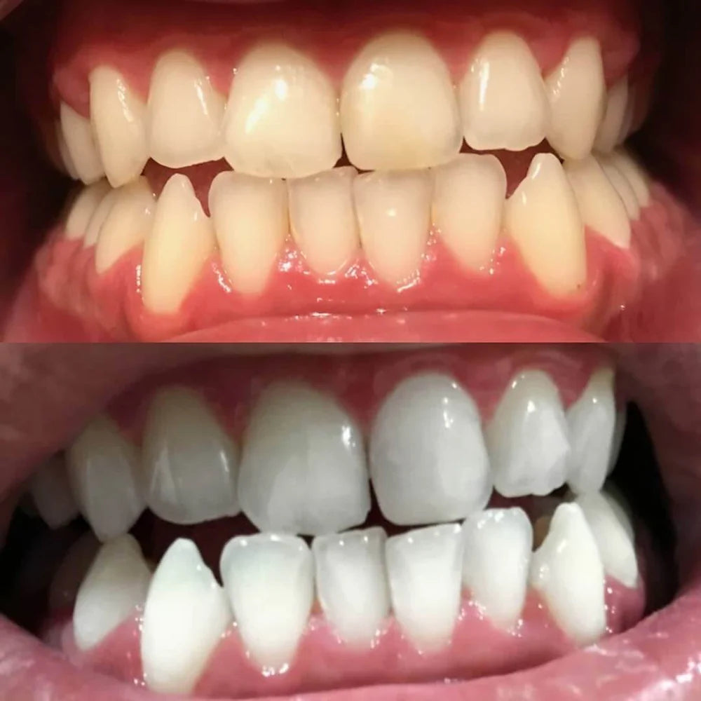 DiamondShine™ — Ignite Instant Confidence with a Flawless, Head-Turning Smile