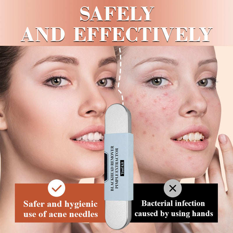 Stainless steel blackhead removal kit