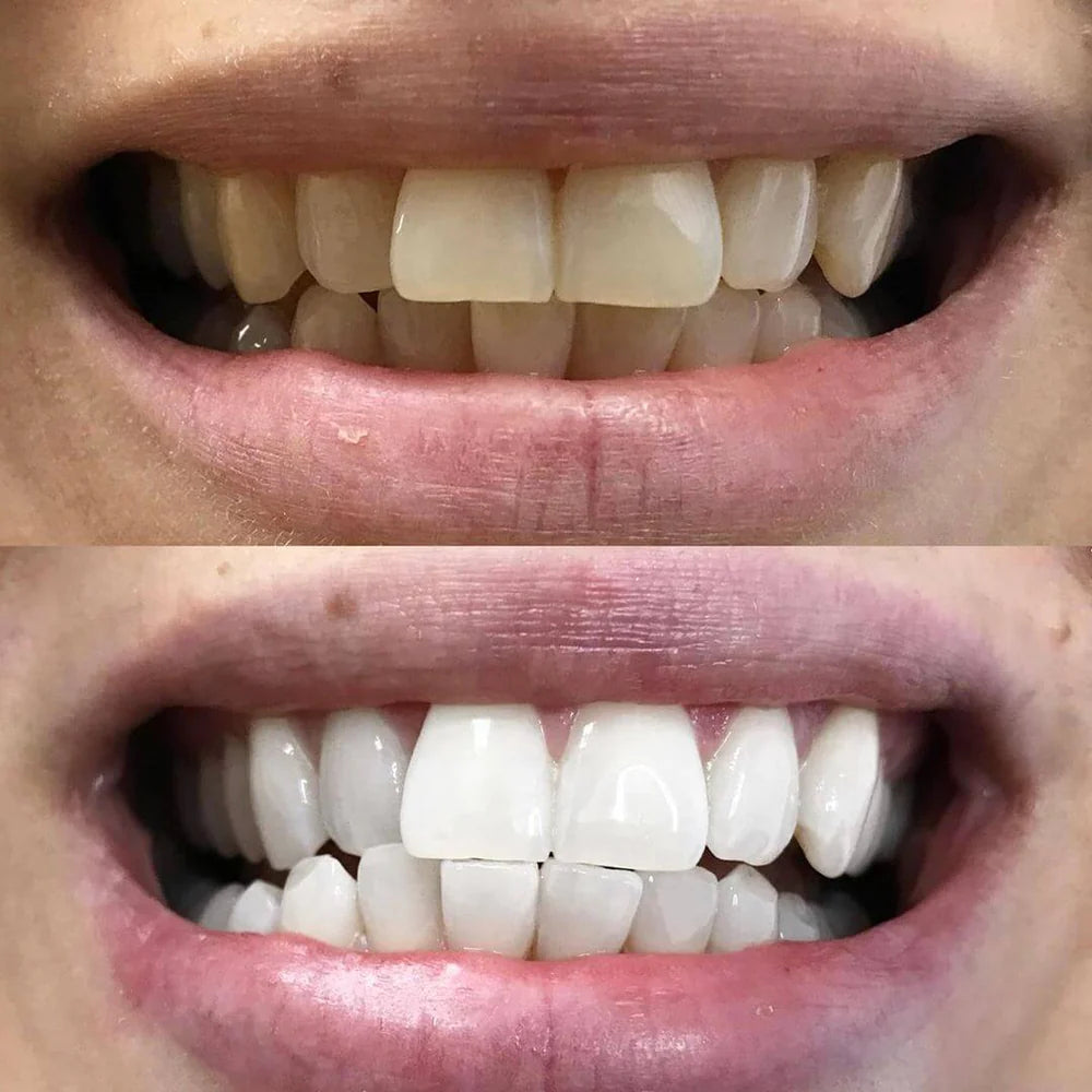 DiamondShine™ — Ignite Instant Confidence with a Flawless, Head-Turning Smile