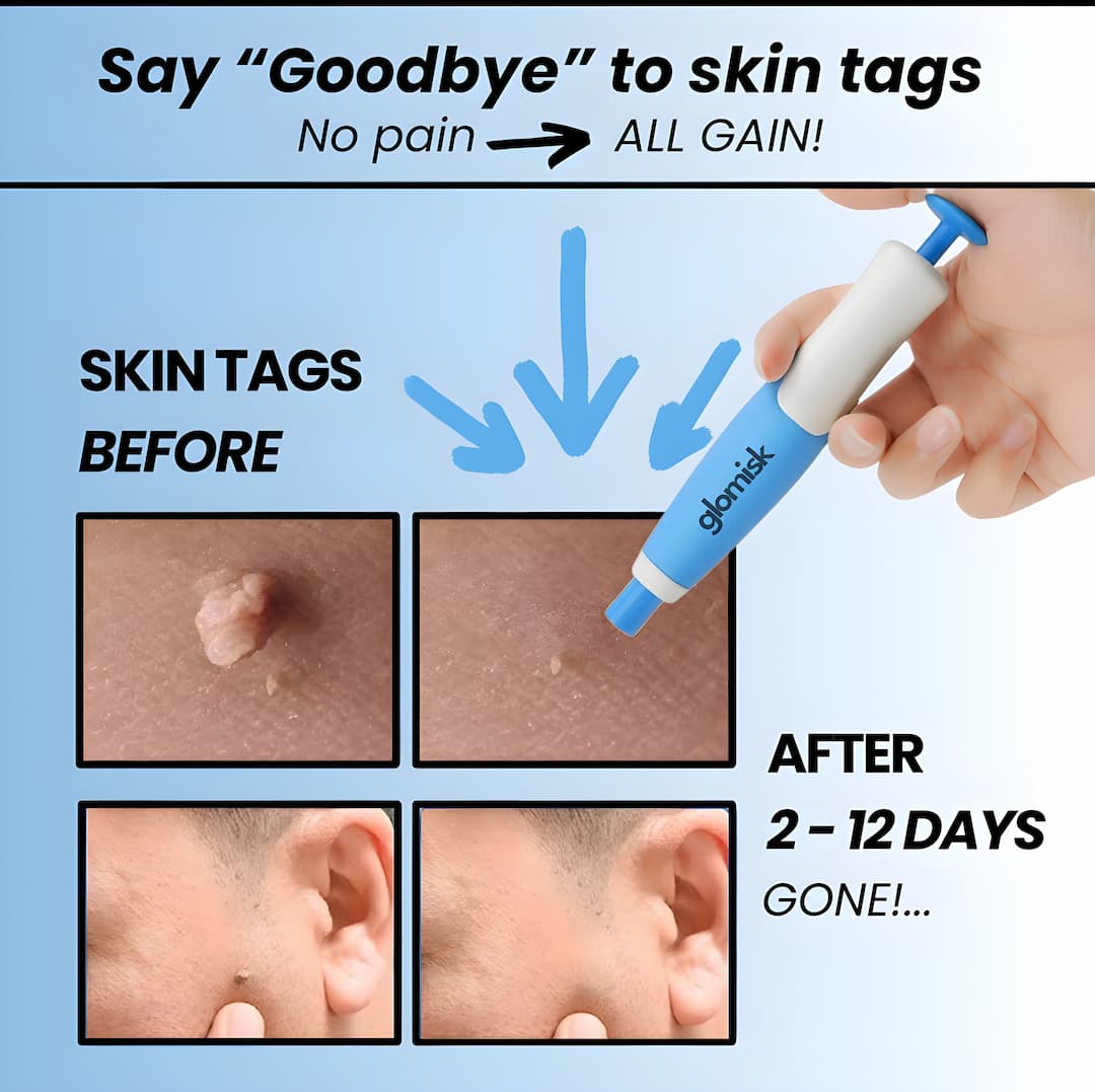 DermaLift™ — Experience Painless Skin Tag Freedom and Radiate Confidence Quickly