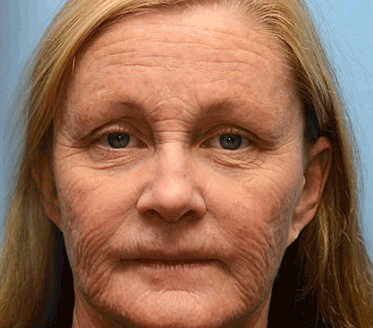 ReviRadiance™ — Unlock Youthful Lift and Radiance Without Needles or Waiting