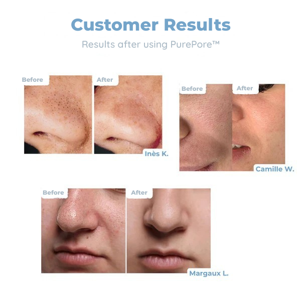 PurePore™ — Deep-Cleansing Power for Smooth, Confidence-Boosting Skin