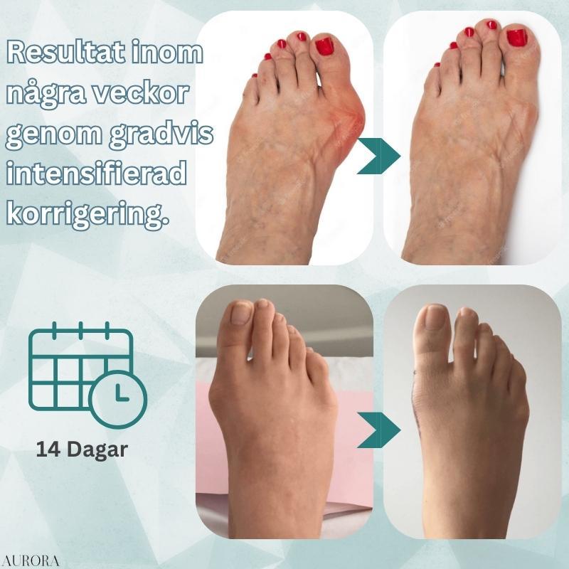 Bunion Correction Splint for Hallux Valgus