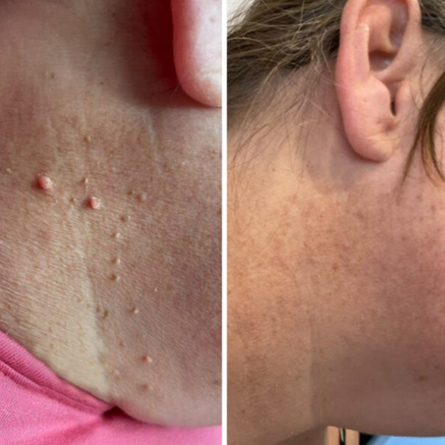 DermaluxePro™ — Effortlessly Erase Skin Tags for Smooth, Scar-Free Confidence