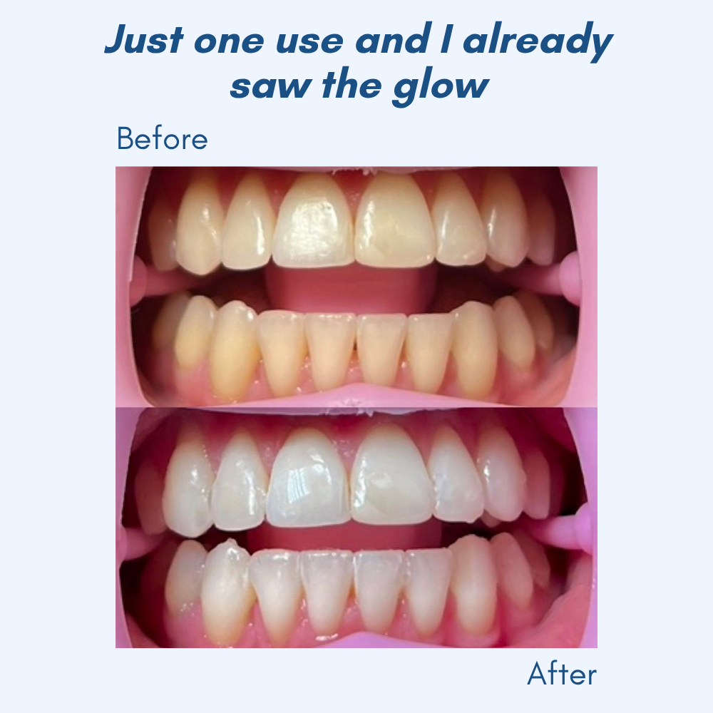LumaShine™ — Glow Brighter Instantly with a Comfortable, Confidence-Boosting Smile