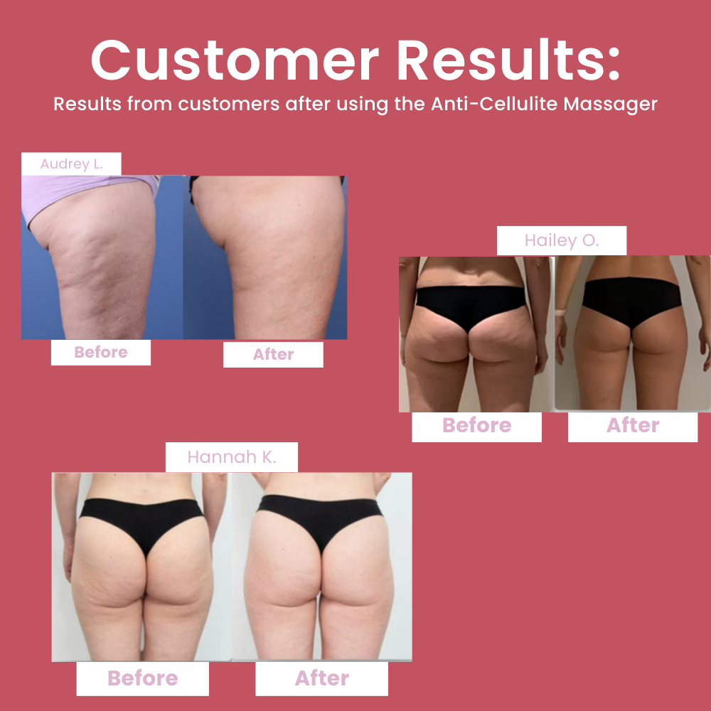 Arivarlo™ - Anti-Cellulite Massager