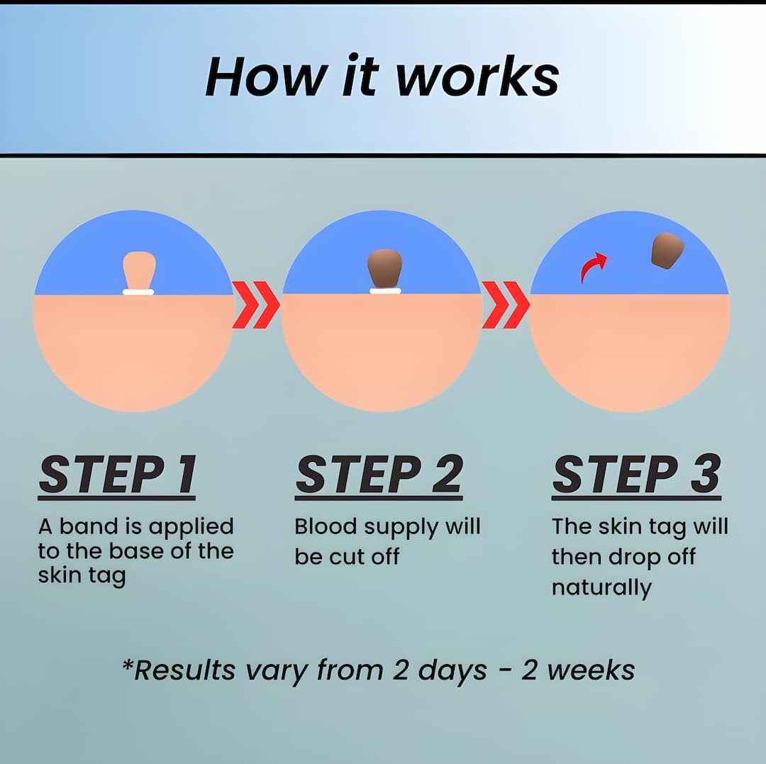 DermaLift™ — Experience Painless Skin Tag Freedom and Radiate Confidence Quickly