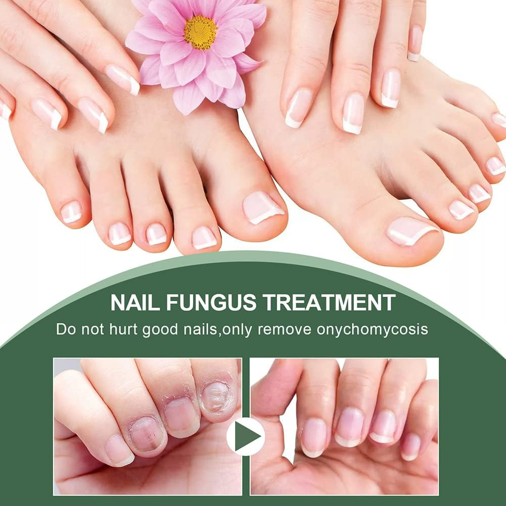 FungiFreeze™ — Unlock Clear, Healthy Nails and Step Out with Confidence