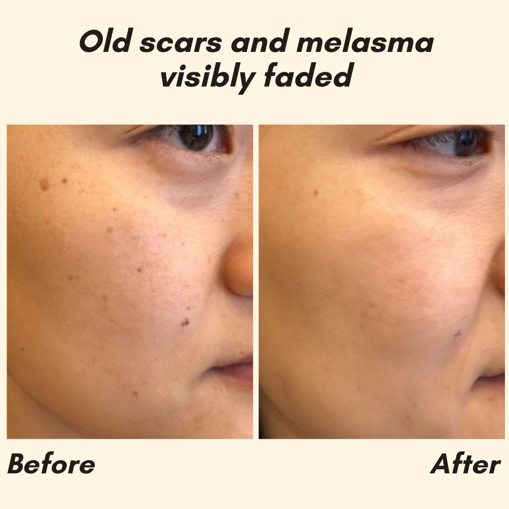 EELHOE Eternity™ — Erase Dark Spots, Reveal Glowing Skin | 1+1 FREE
