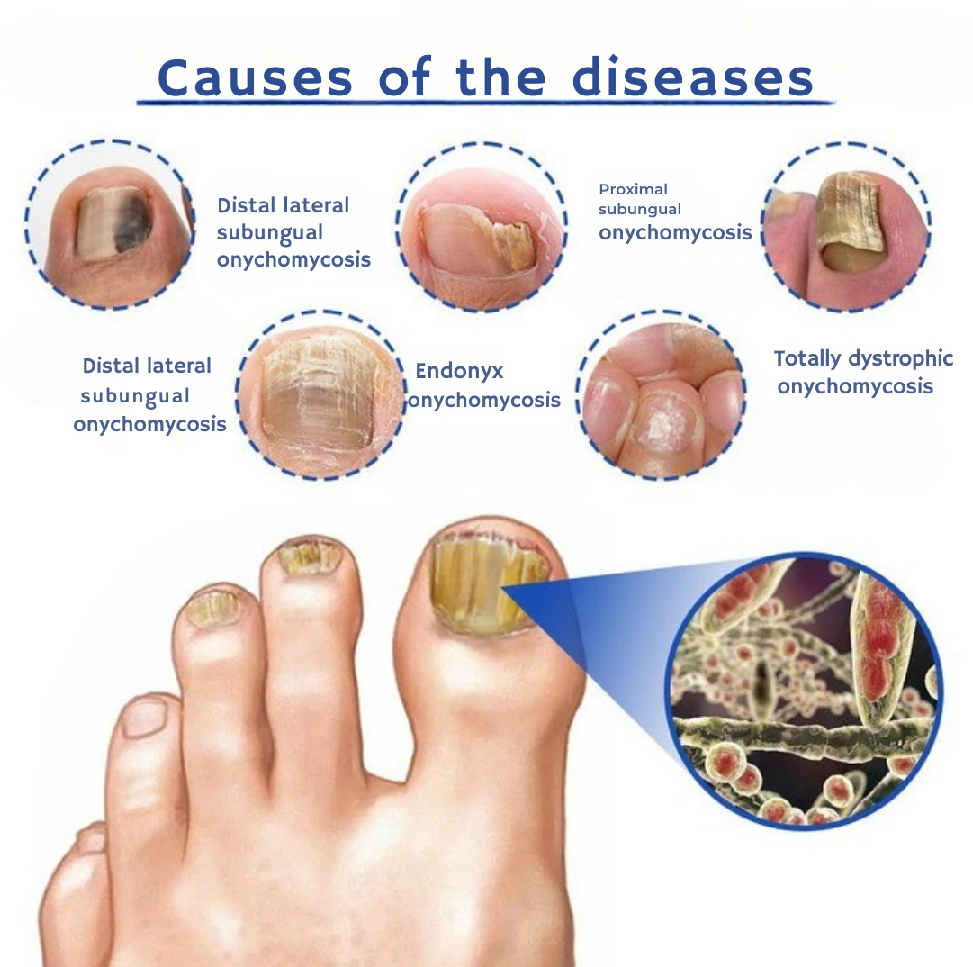 NailedIt™ | Say goodbye to thick, discolored nails without pain — no medication needed