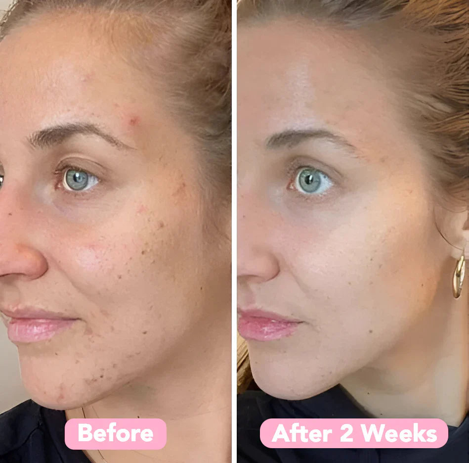 LumiDerm™ — Transform Your Skin with a Radiant, Spot-Free Glow in Just Weeks