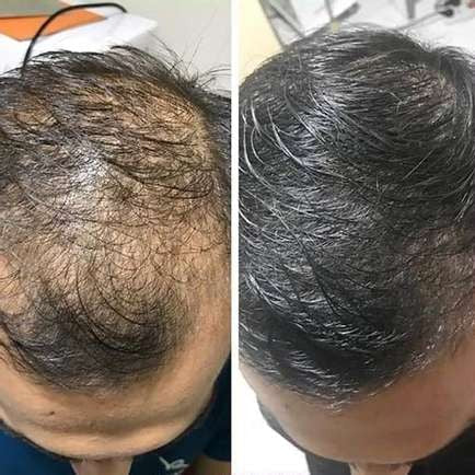 1+1 FREE | RiceGlow™ - Anti-Hair Loss (Last Day Discount)