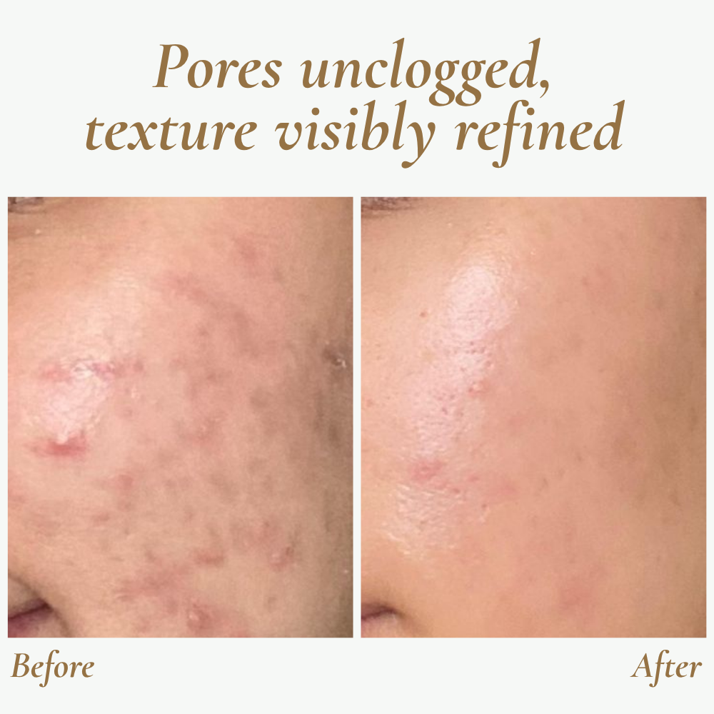 SkinPulse™ - Professional Ultrasonic Skin Cleansing