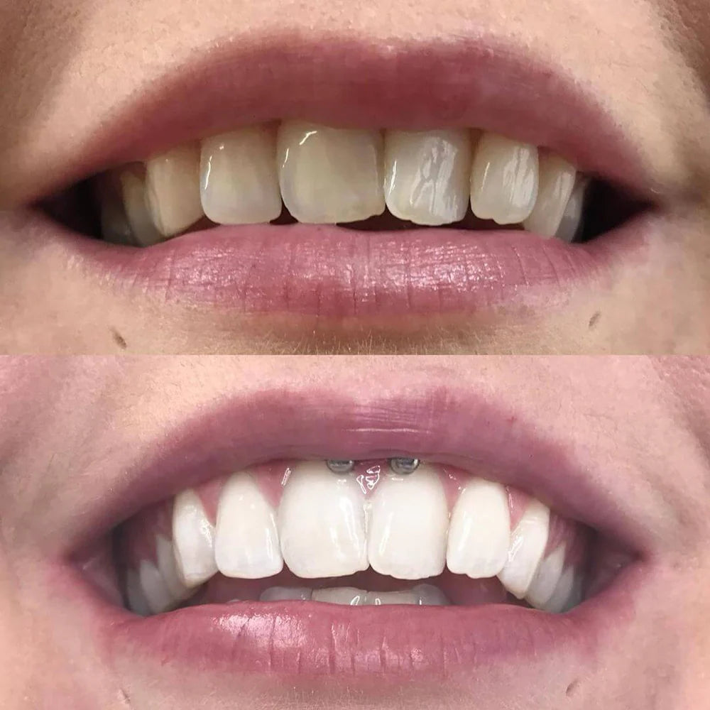 DiamondShine™ — Ignite Instant Confidence with a Flawless, Head-Turning Smile