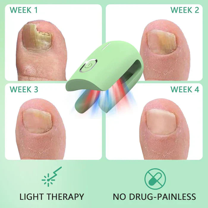 Laser Treatment Device for Toenail Fungus Therapy