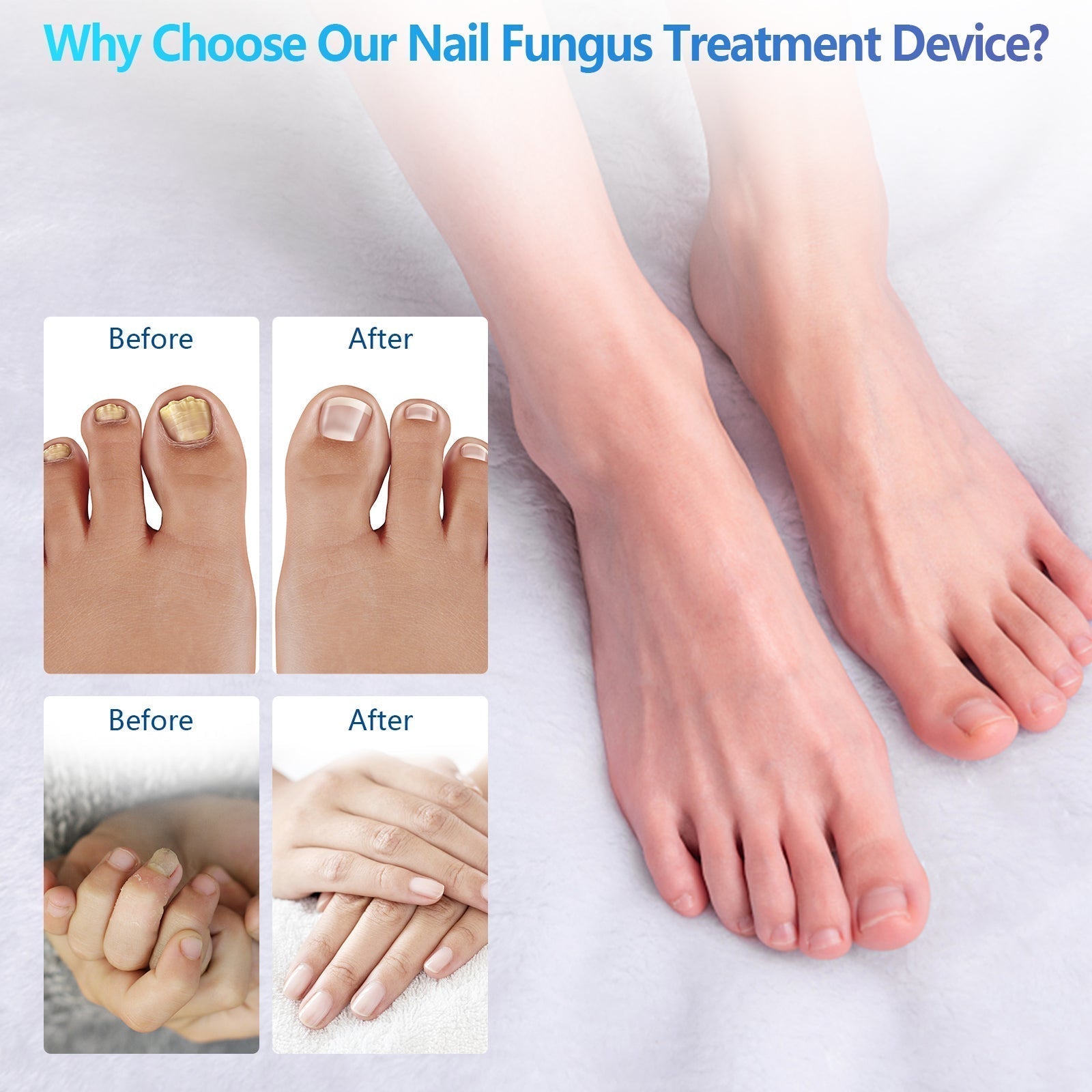Portable Laser Therapy Device for Nail Cleaning - FDA Cleared