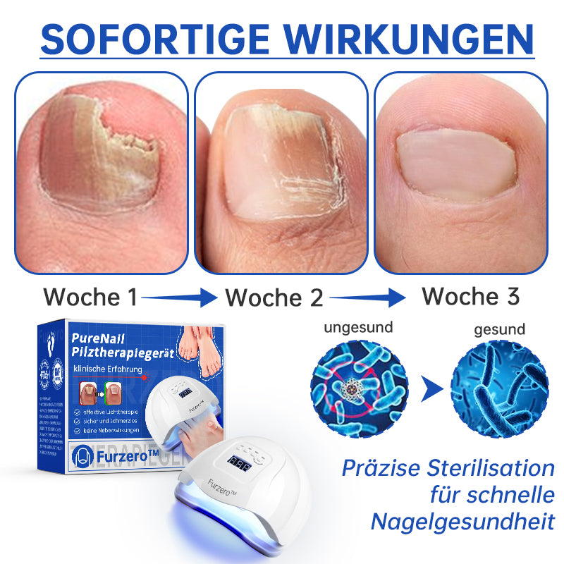 FungiFade™ — Pain-Free Laser Therapy that Restores Gorgeous, Fungus-Free Nails Fast
