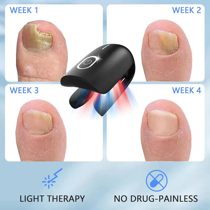 Onychomycosis Treatment Device for Nail Fungus Removal
