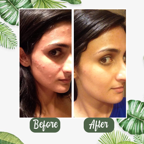 PurifyMist™ — Unleash Clear, Radiant Skin That Glows with Confidence