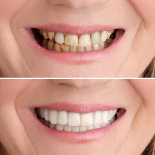 RadianceWrap™ — Transform Your Smile Instantly for Unstoppable Confidence