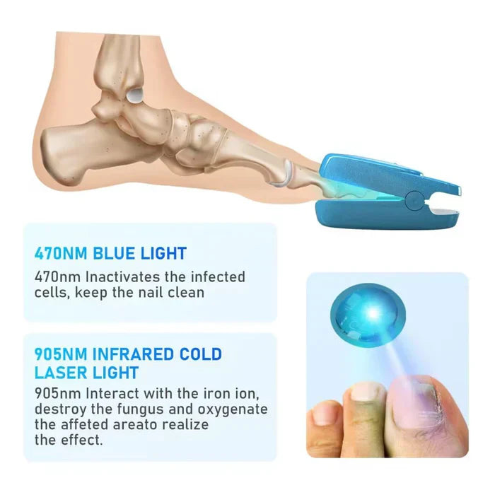 Nail Fungus Laser Treatment Device for Onychomycosis