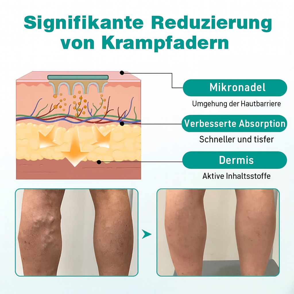 VenoLift Patches – Relief for Painful, Visible Veins