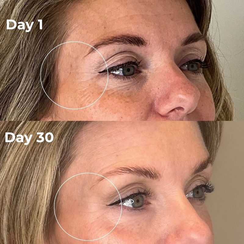 Red Light Therapy Device for Under Eye Treatment at Home
