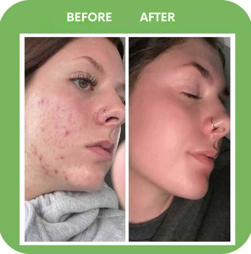 GlowStream™ — Clear Away Breakouts for Radiant, Silky-Soft Skin That Turns Heads