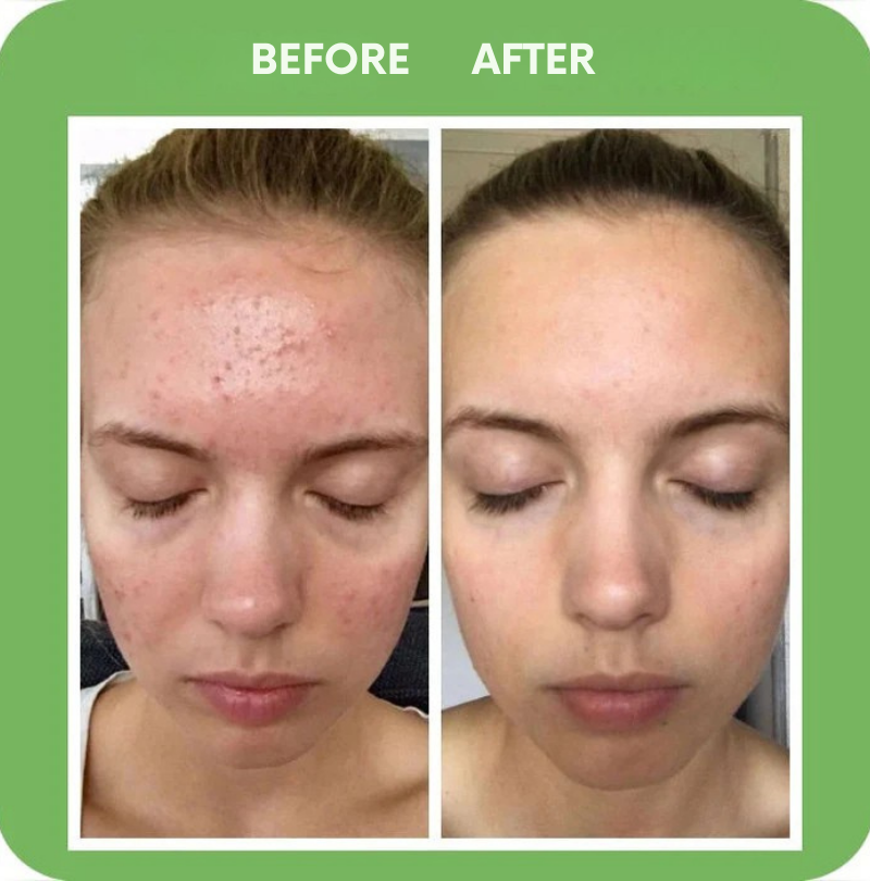 GlowStream™ — Clear Away Breakouts for Radiant, Silky-Soft Skin That Turns Heads