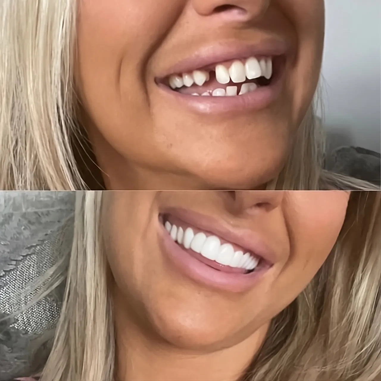 RadianceSnap™ Clip-On Veneers — Effortless Glamour That Boosts Your Confidence Instantly
