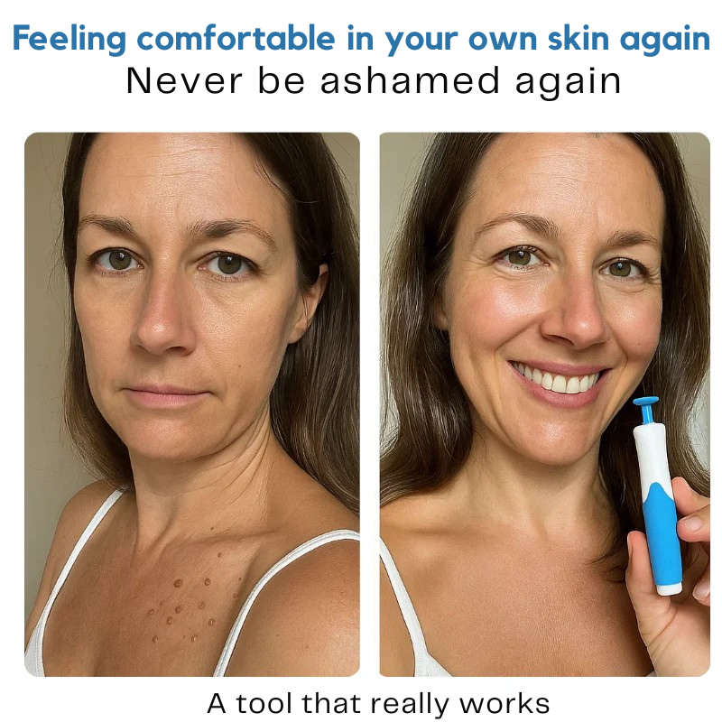 DermaluxePro™ — Effortlessly Erase Skin Tags for Smooth, Scar-Free Confidence