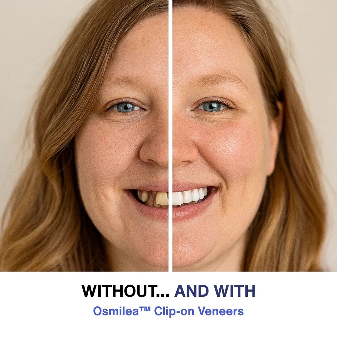 RadianceSnap™ Clip-On Veneers — Effortless Glamour That Boosts Your Confidence Instantly