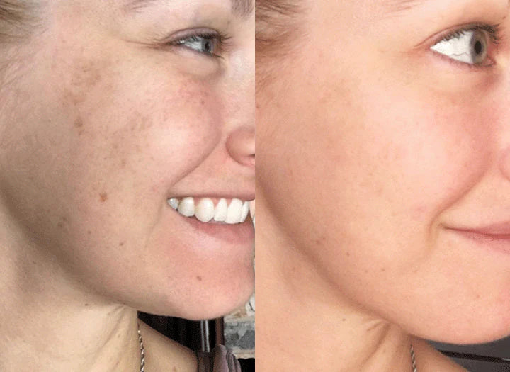 LumiDerma™ — Erase Dark Spots and Unleash Your Radiant Glow