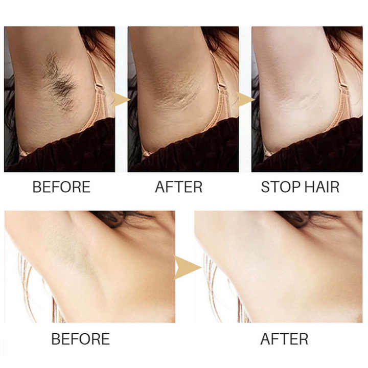 SilkEase™ — Enjoy Lasting Smoothness That Lets You Forget Hair Hassles Forever