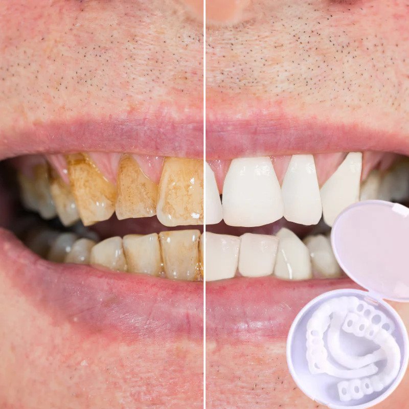 Snap-on Teeth - With these veneers, always have the perfect smile.