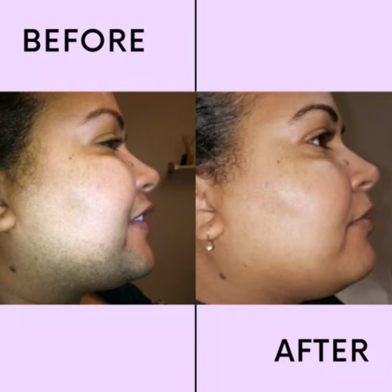 LumiSilk™ — Instantly Smooth, Radiant Skin Without a Sting or Scratch