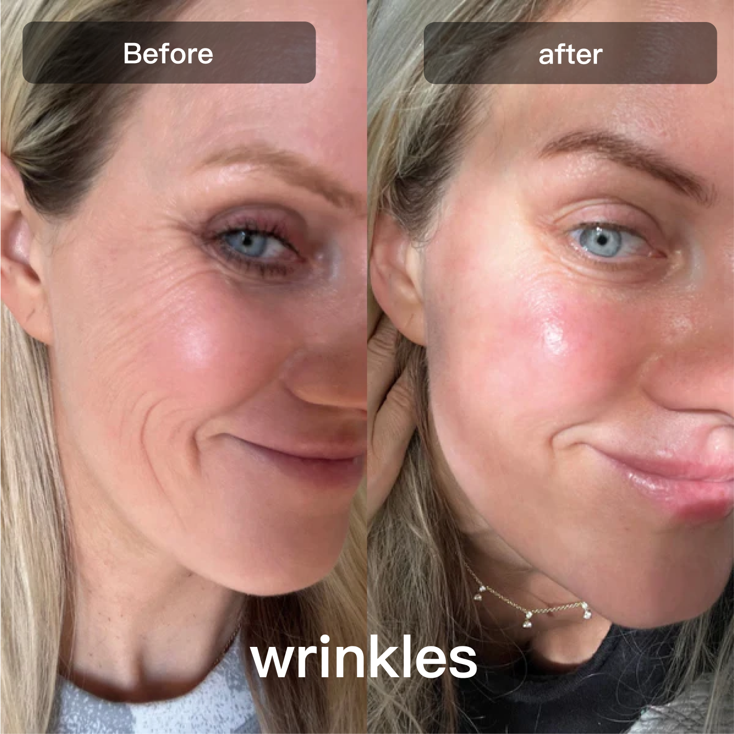 Light Therapy Device for Skin Care on Face and Body