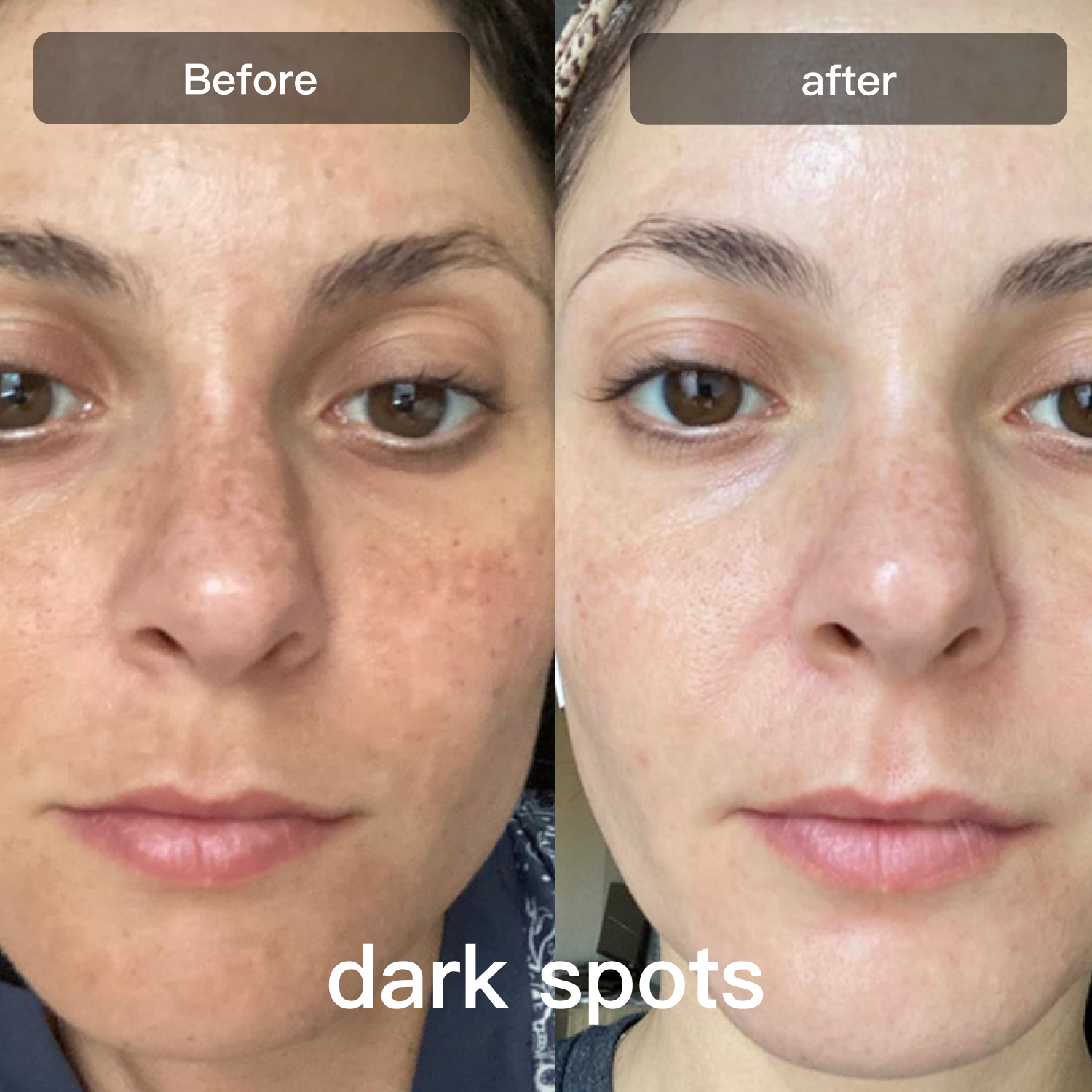 Light Therapy Device for Skin Care on Face and Body