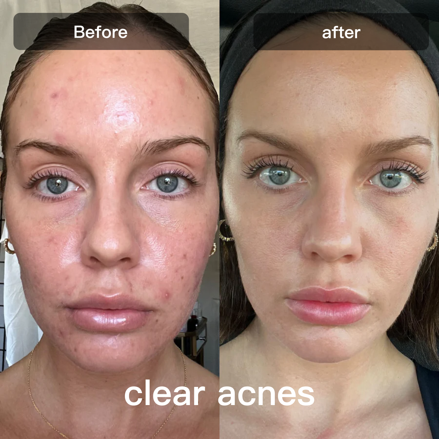 Light Therapy Device for Skin Care on Face and Body