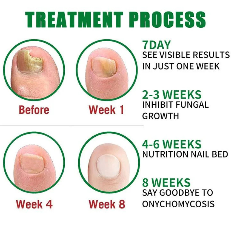 Nail Treatment - Natural Anti-Fungal Treatment
