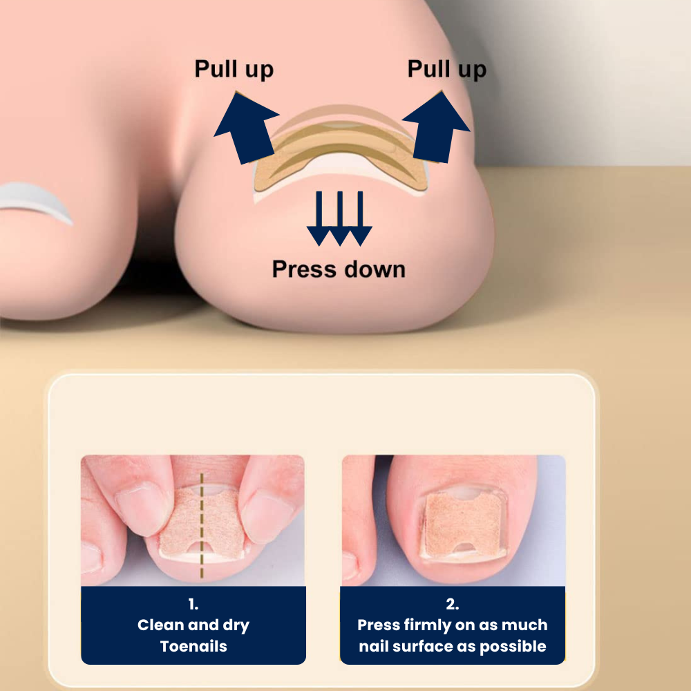 FinePatches™ | Correction Patches for Beautiful and Healthy Nails
