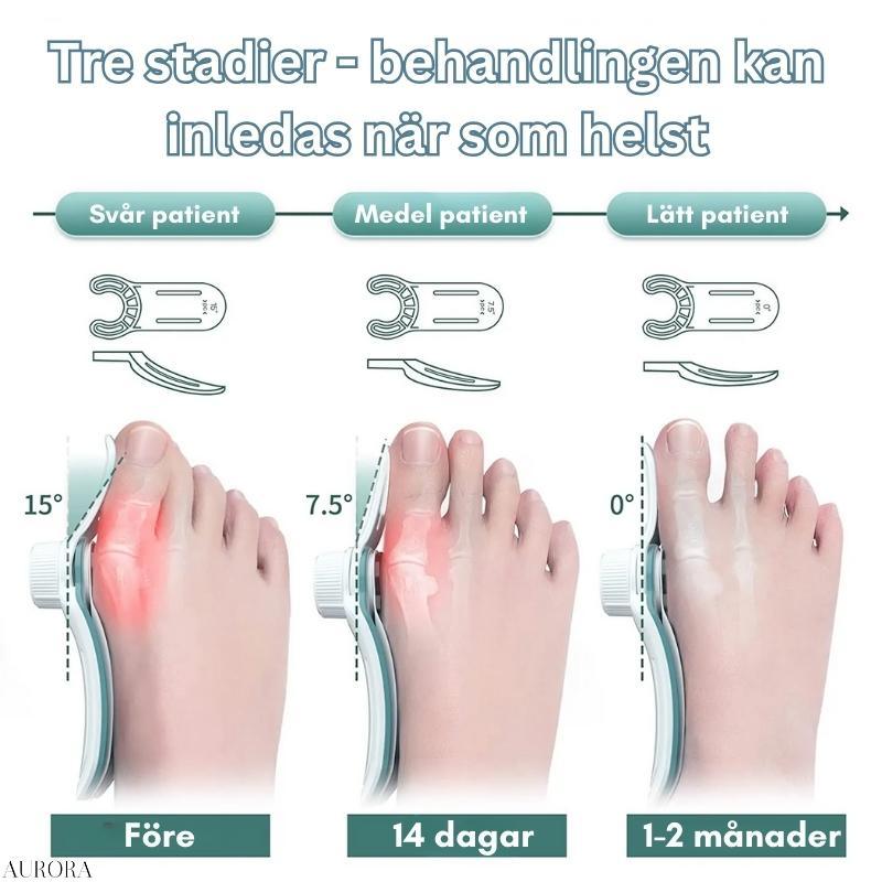 Bunion Correction Splint for Hallux Valgus