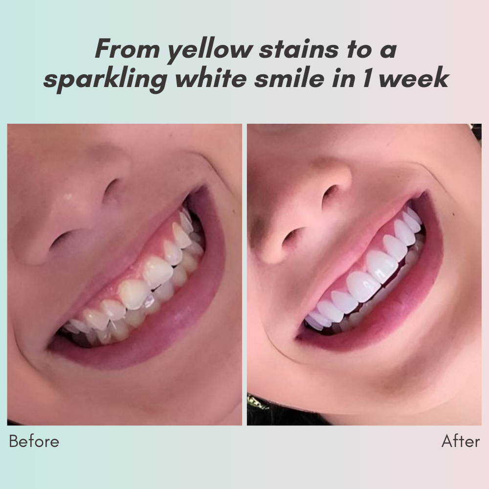 LumaCrest™ — Unleash a Radiant Smile and Heal Your Gums for Lasting Confidence