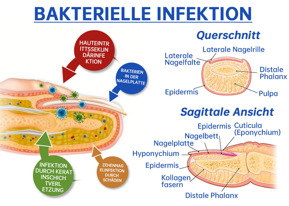 PureNail | Nail Fungus Laser Therapy Device - Your Secret Weapon Against Nail Fungus