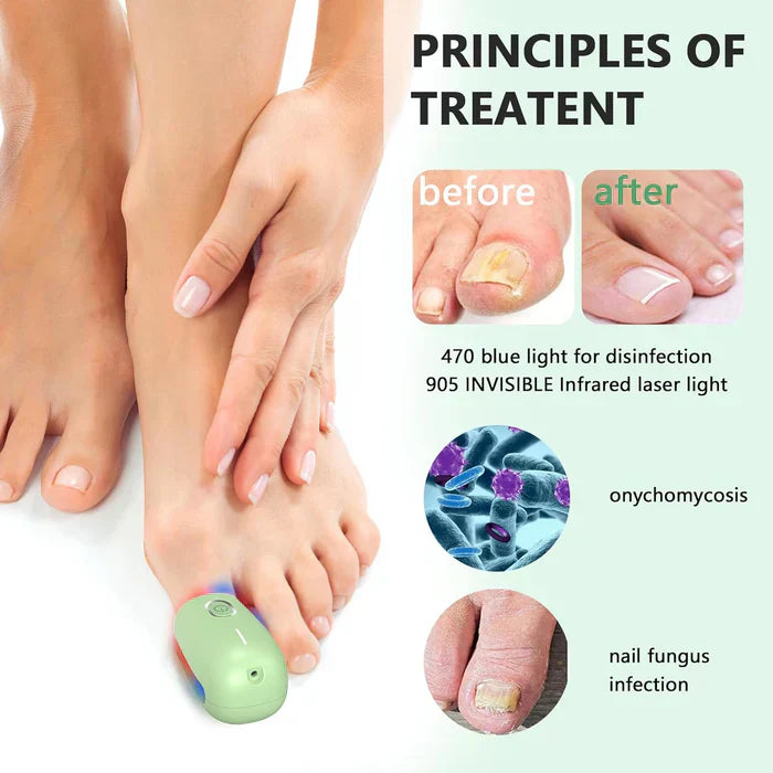Onychomycosis Treatment Device for Nail Fungus Removal