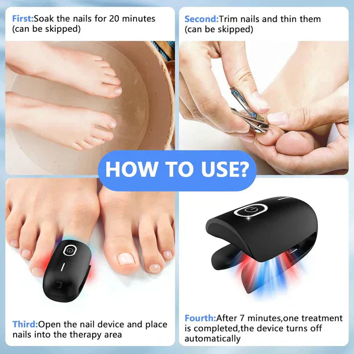 Onychomycosis Treatment Device for Nail Fungus Removal